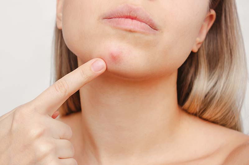 How to properly pop a pimple